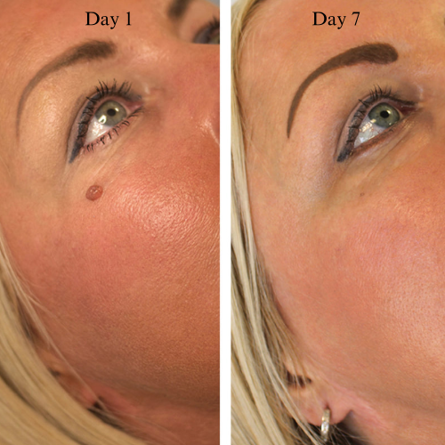MrTagmate™ – No More Skin Tags