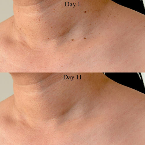 MrTagmate™ – No More Skin Tags