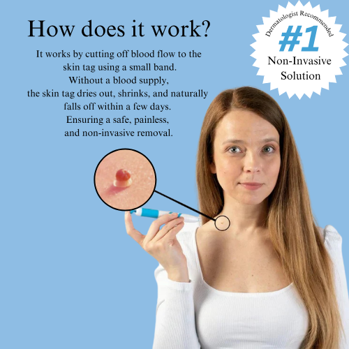 MrTagmate™ – No More Skin Tags