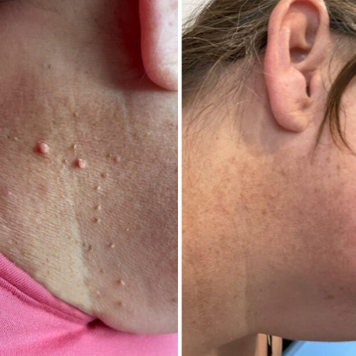 MrTagmate™ – No More Skin Tags