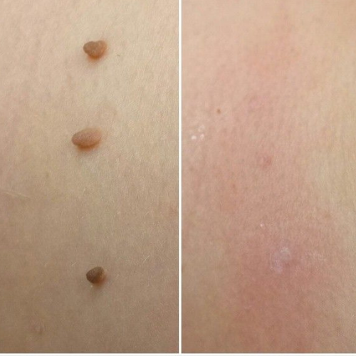 MrTagmate™ – No More Skin Tags