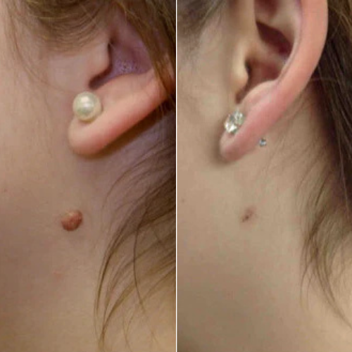 MrTagmate™ – No More Skin Tags
